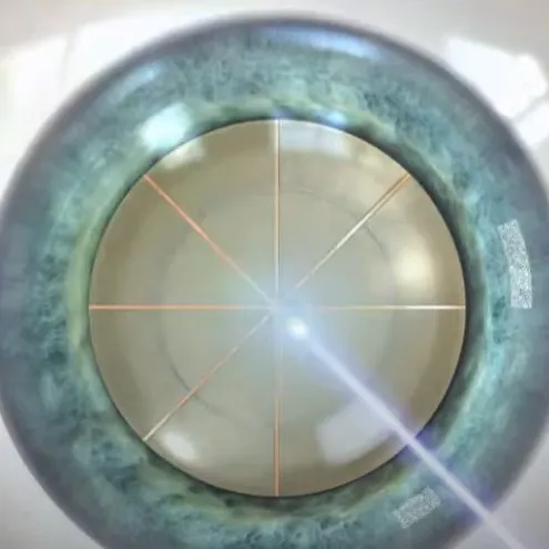 The No-Blade RLE Surgical Procedure